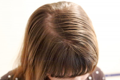 Perawatan Alami untuk Rambut Berminyak dan Lepek